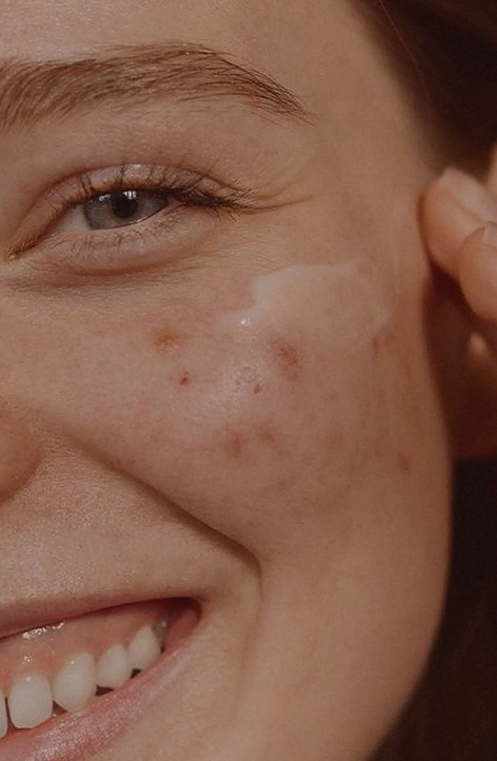 Acne