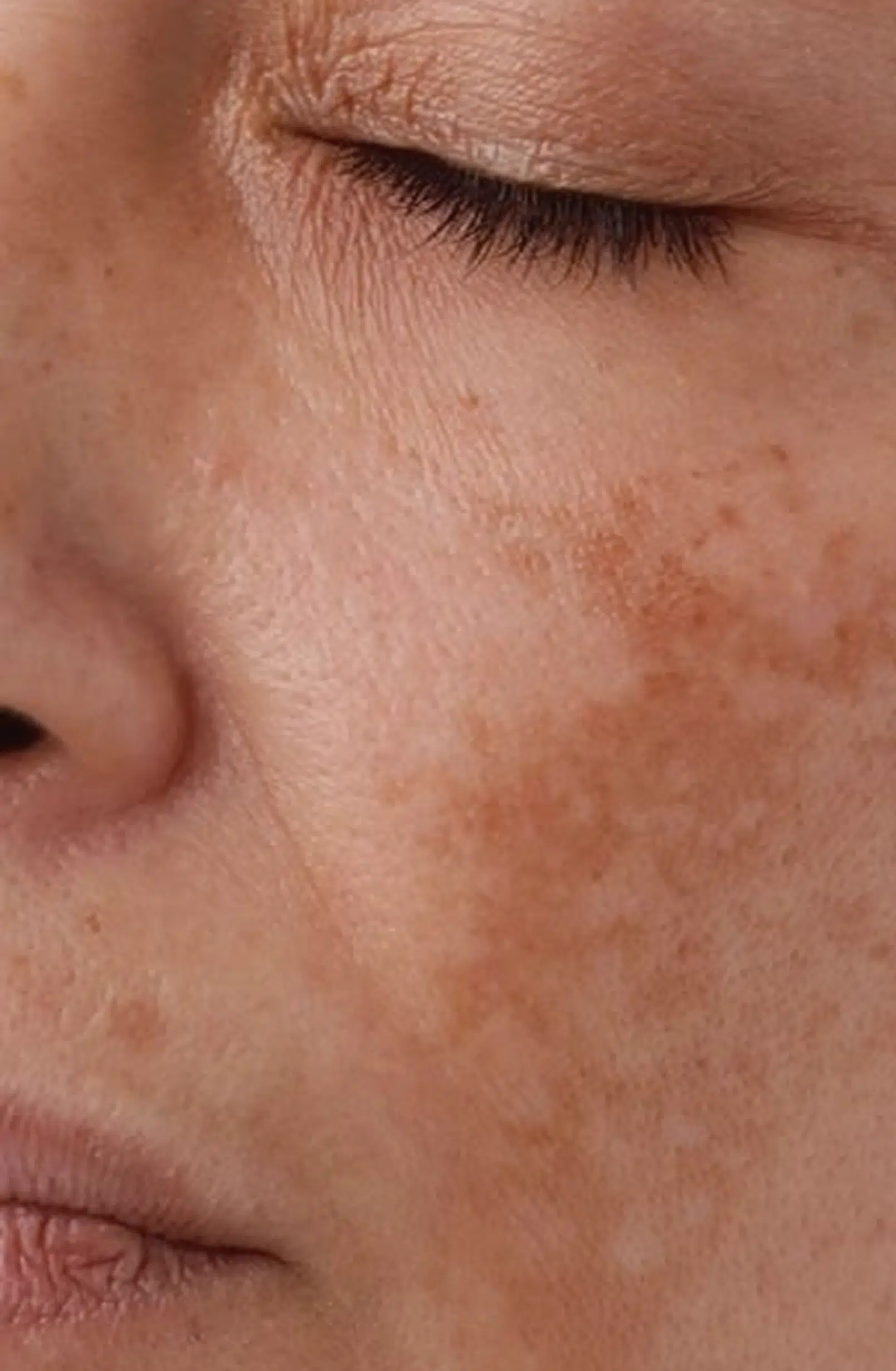 Hyperpigmentation