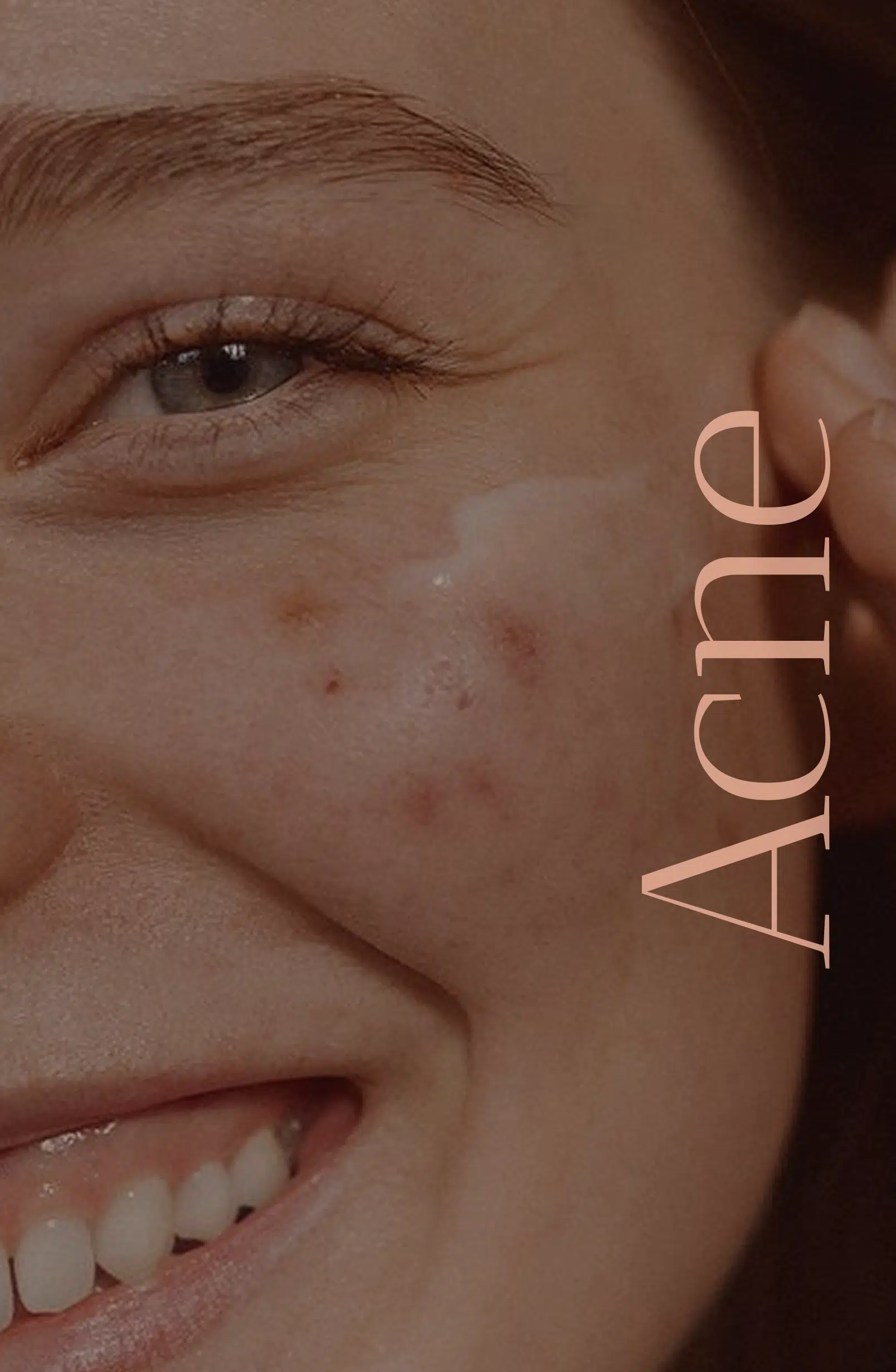 Acne Hover