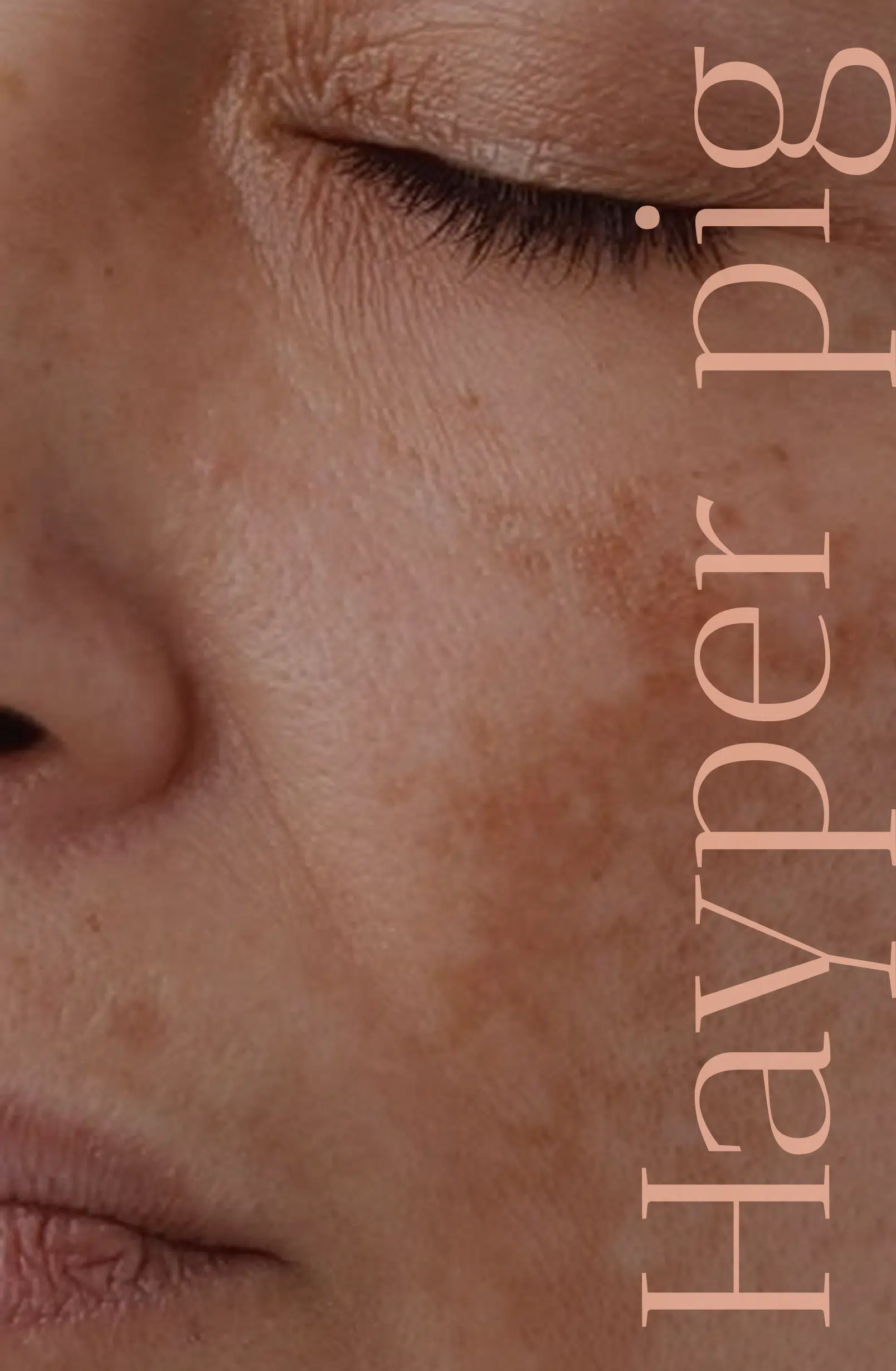Hyperpigmentation Hover